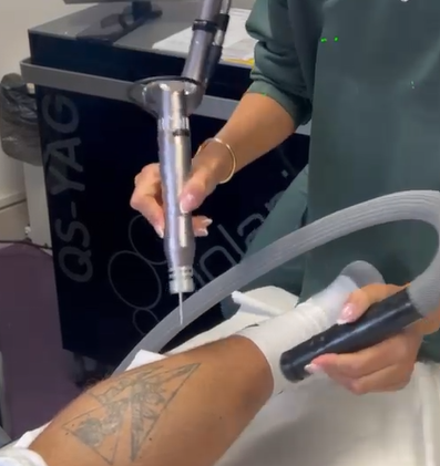 Laser Tattoo Removal
